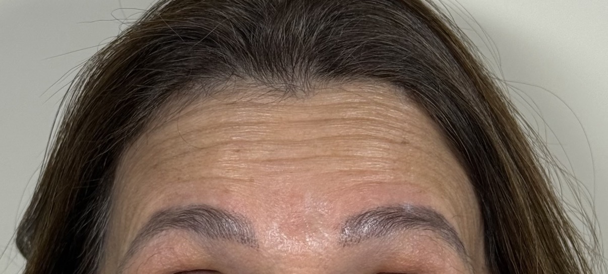 Botox antes