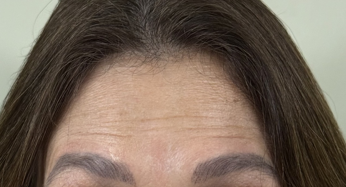 Botox depois