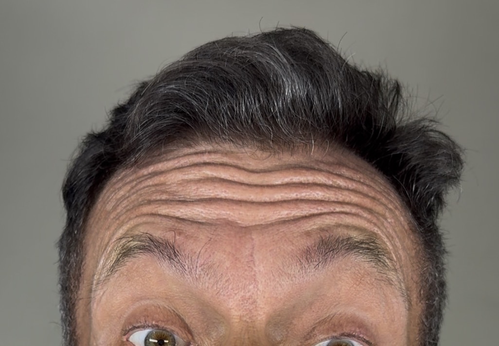Botox antes