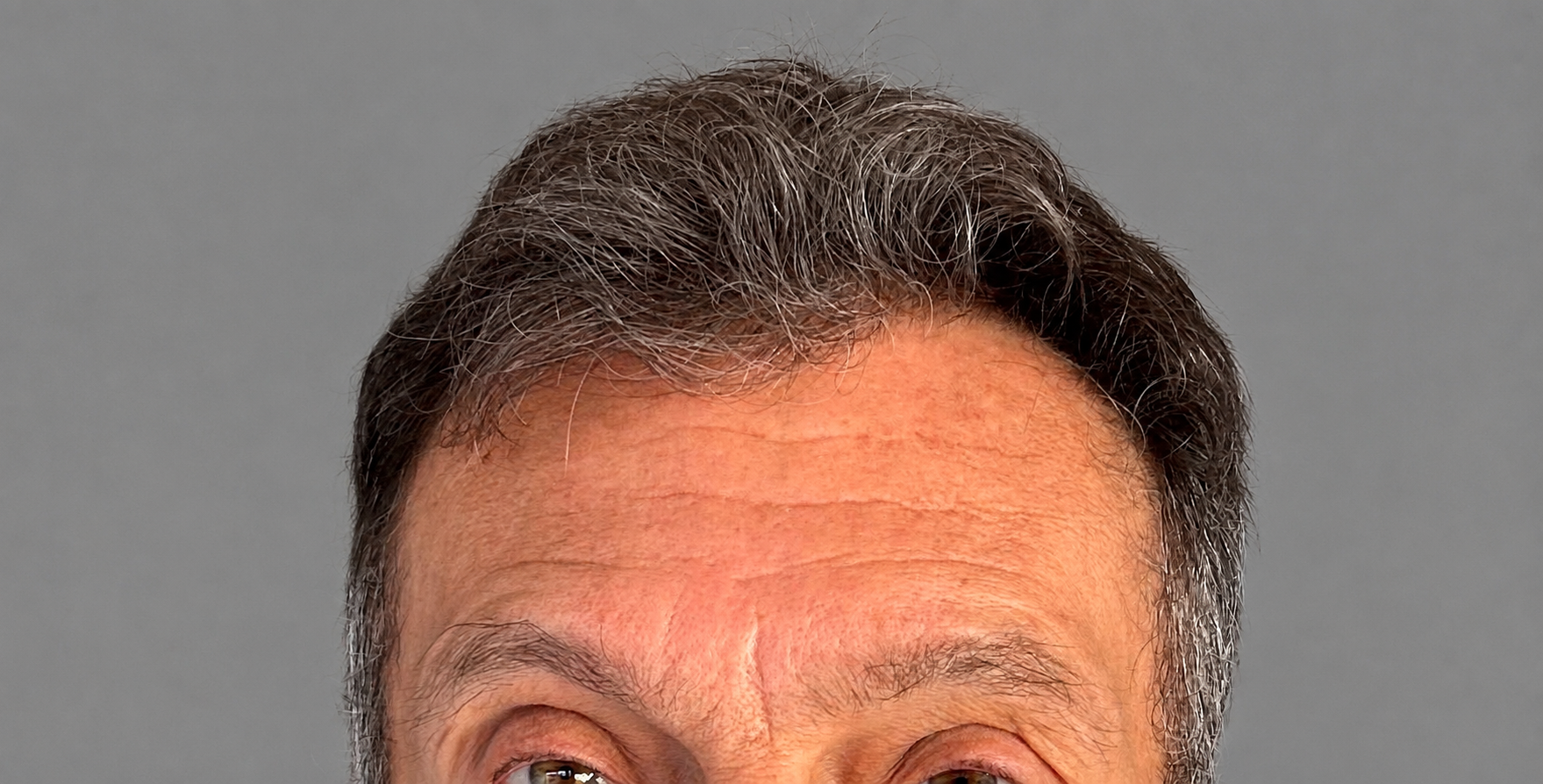 Botox depois