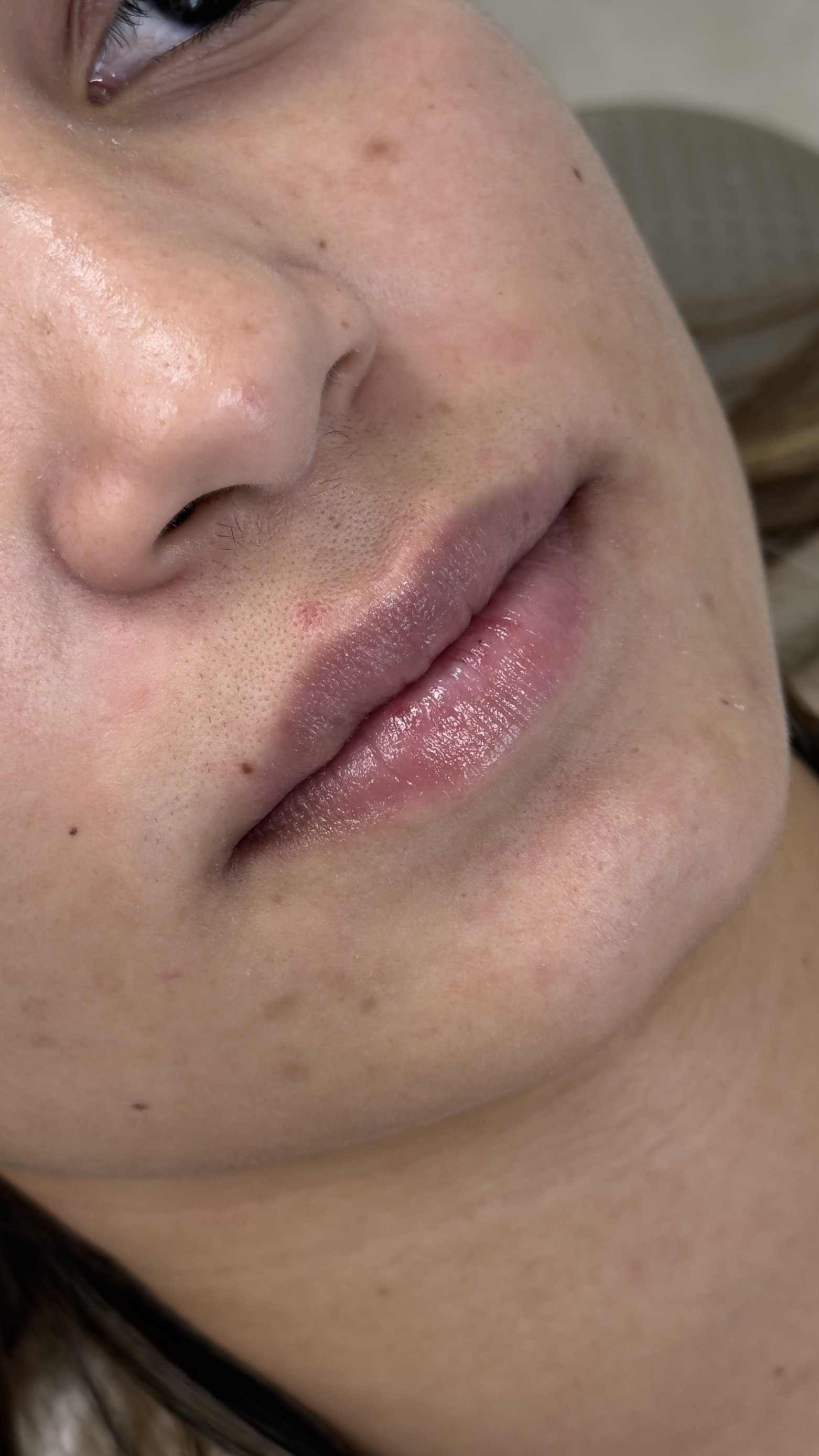 Preenchimento labial antes