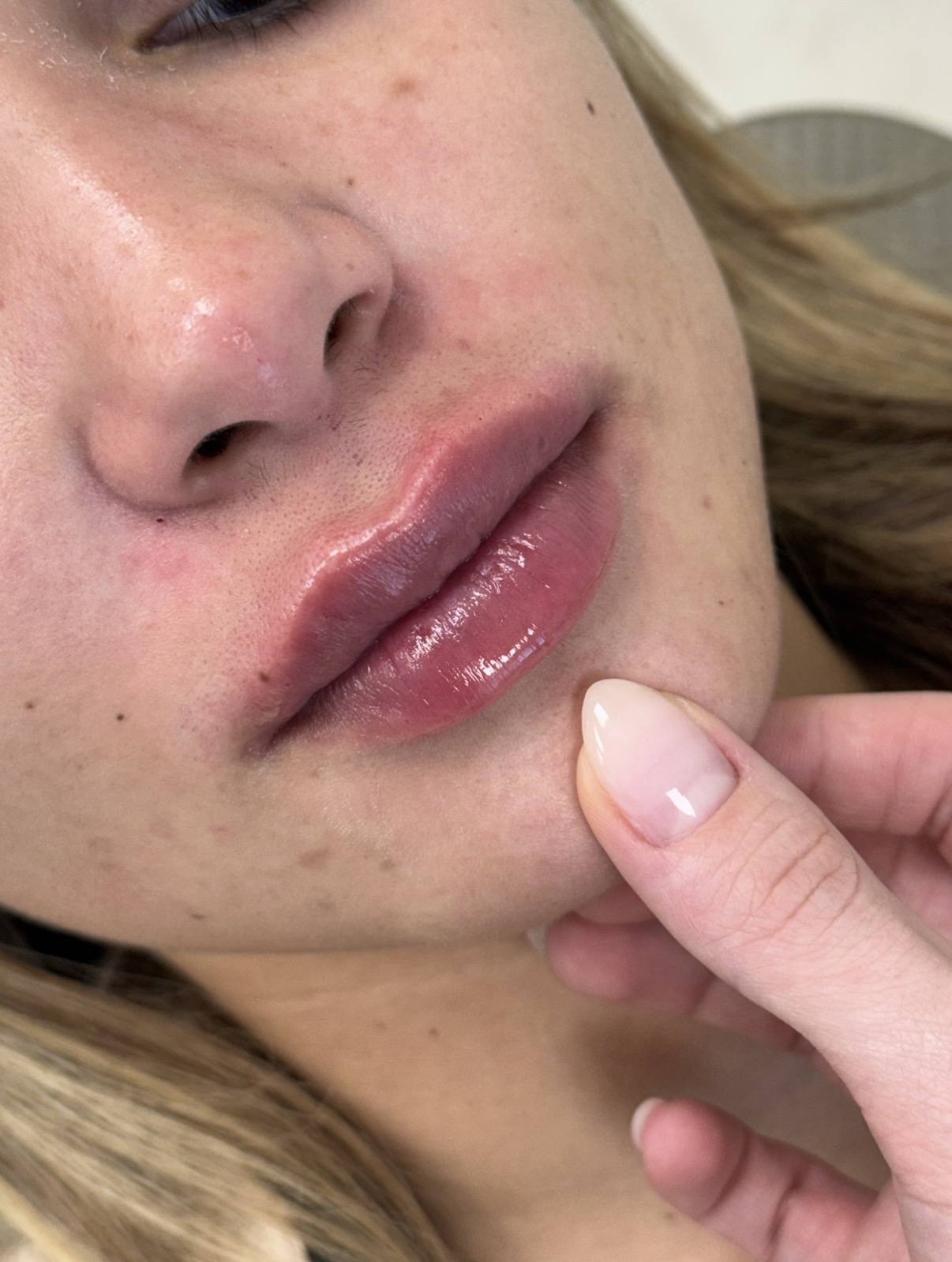 Preenchimento labial depois
