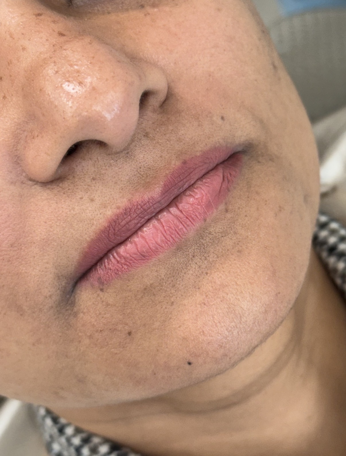 Preenchimento labial antes