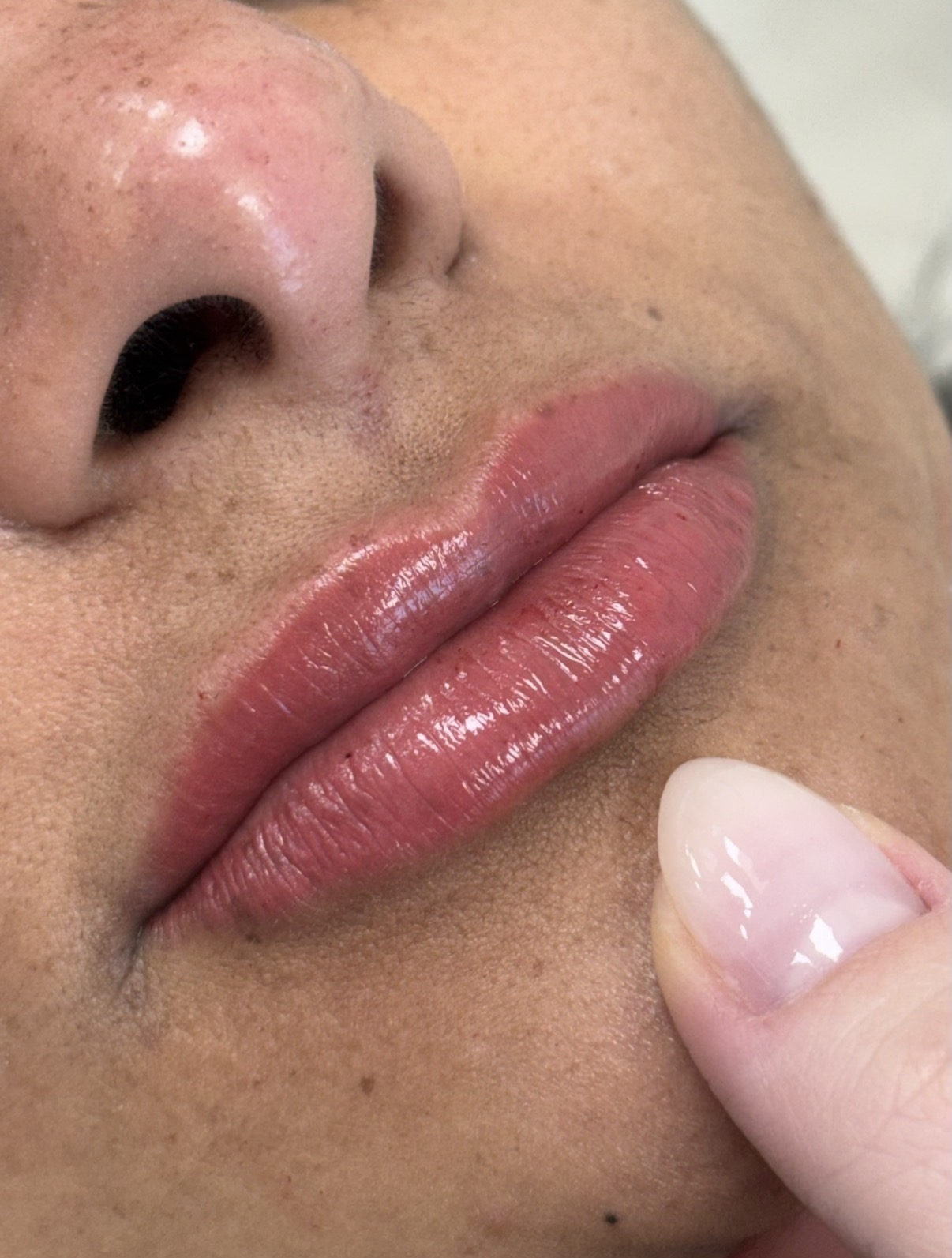 Preenchimento labial depois
