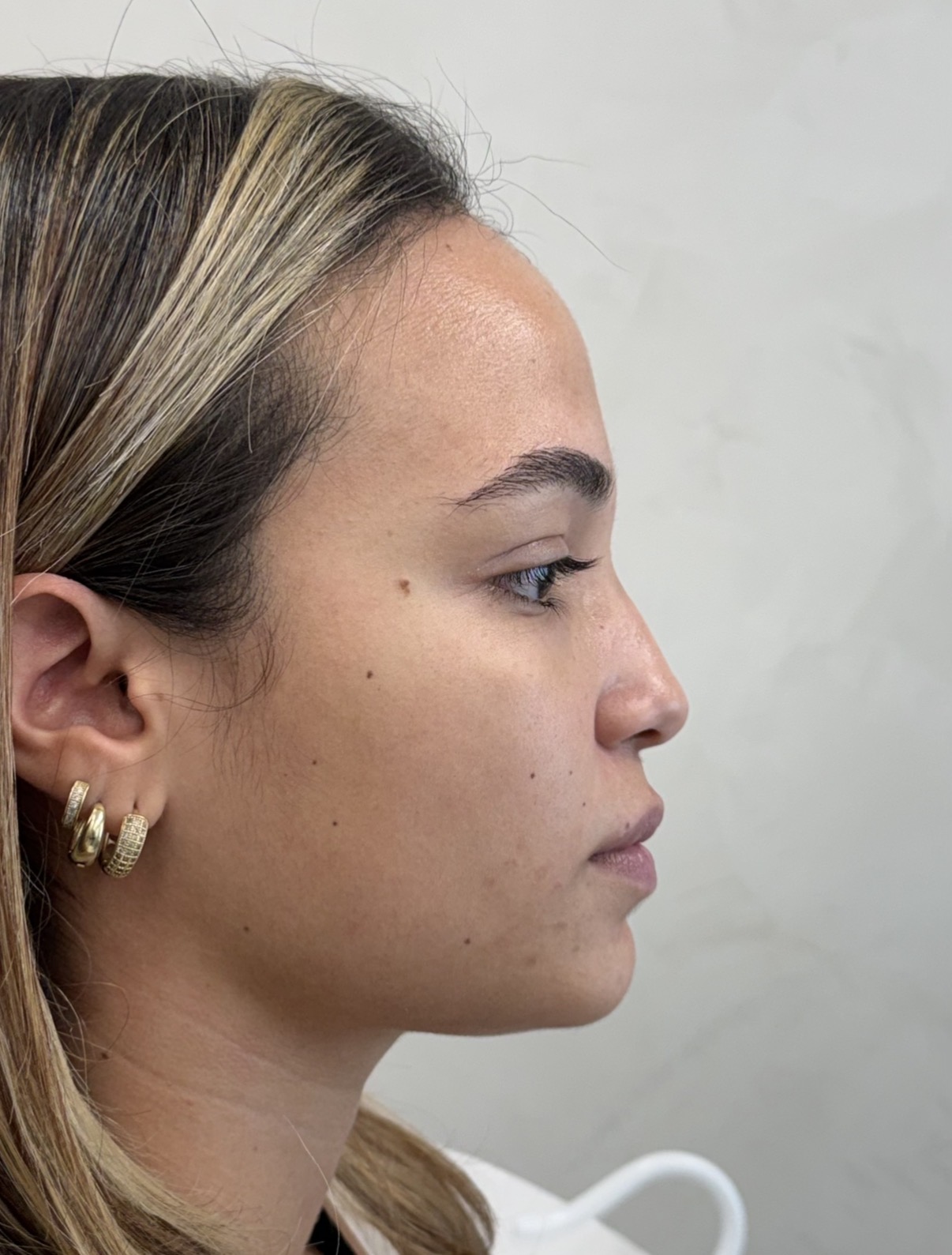 Perfiloplastia antes