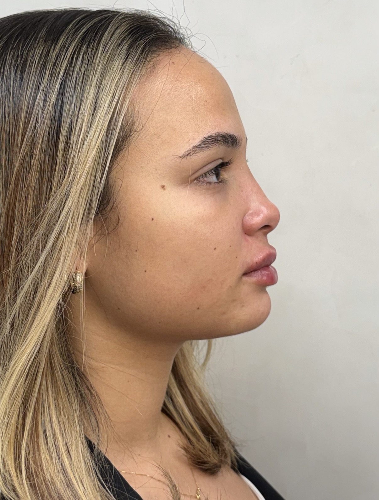 Perfiloplastia depois