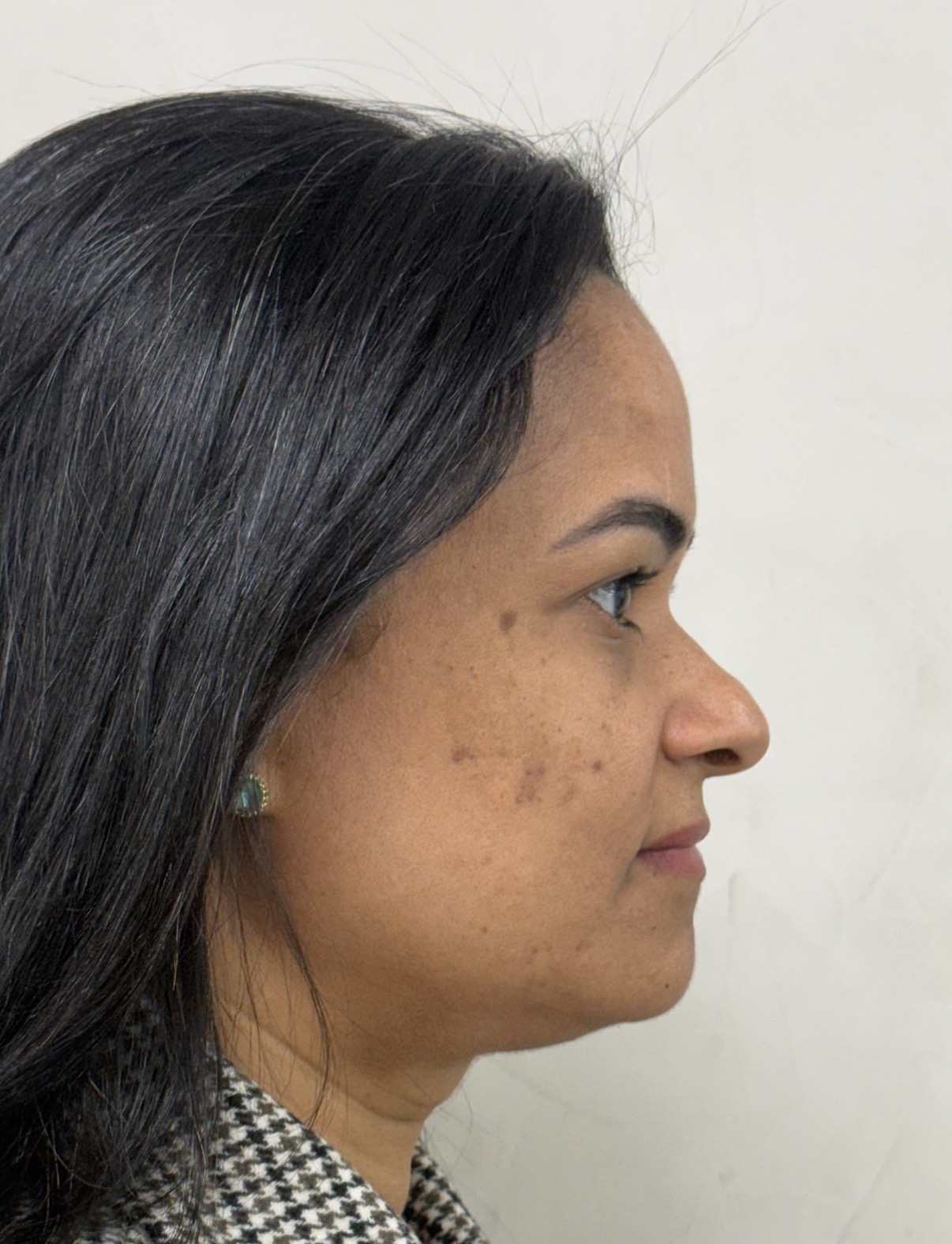 Perfiloplastia antes