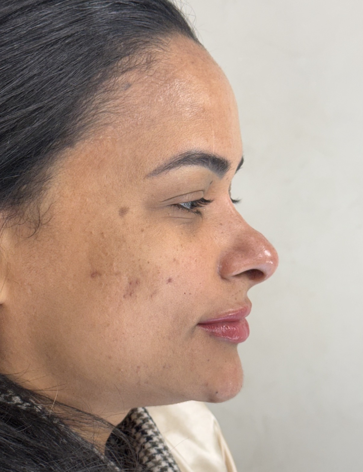 Perfiloplastia depois