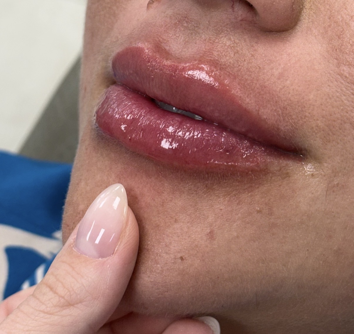 Preenchimento Labial